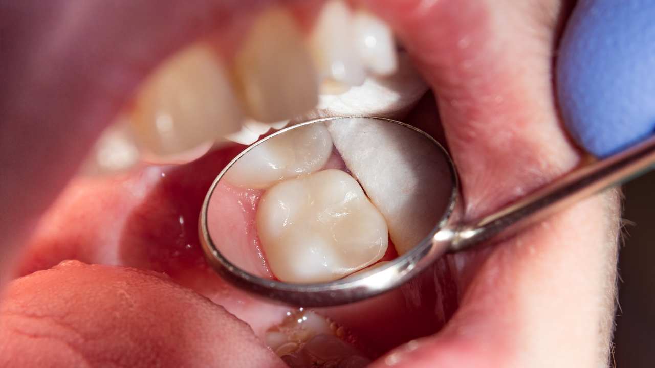 Molar pain: causes and treatment - parkdale family dental