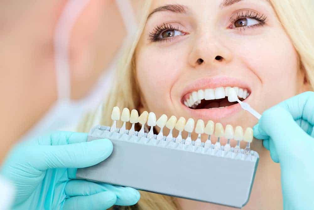 Dental veneers