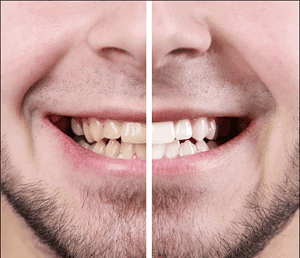 Different Types of Teeth Whitening