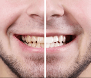 Different Types of Teeth Whitening