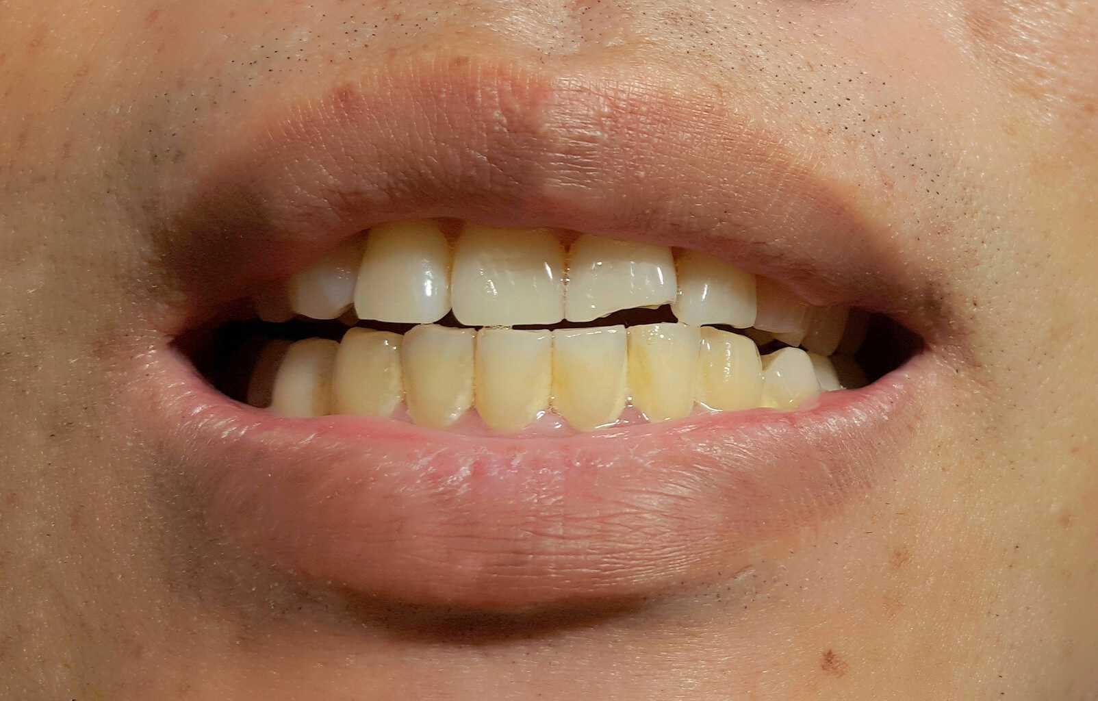 What are The Pros And Cons Of Dental Veneers?
