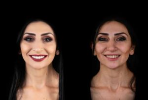 lady with porcelain veneers before and after