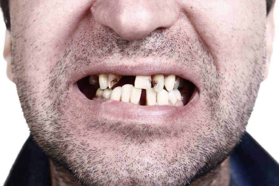 Can Bad Teeth Cause Dizziness