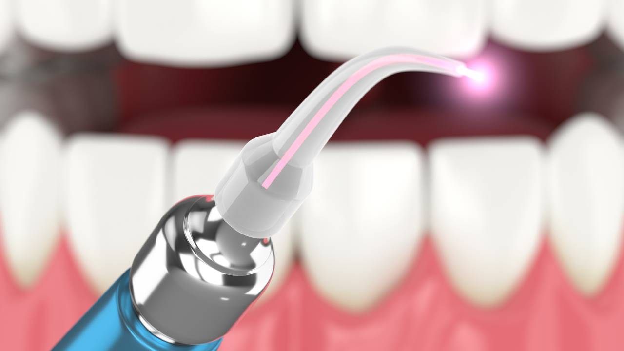 laser dentistry device