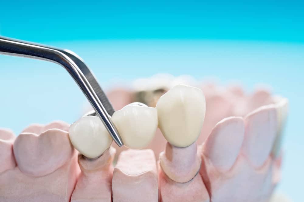 Get Your Smile Back: A Guide to Dental Bridges
